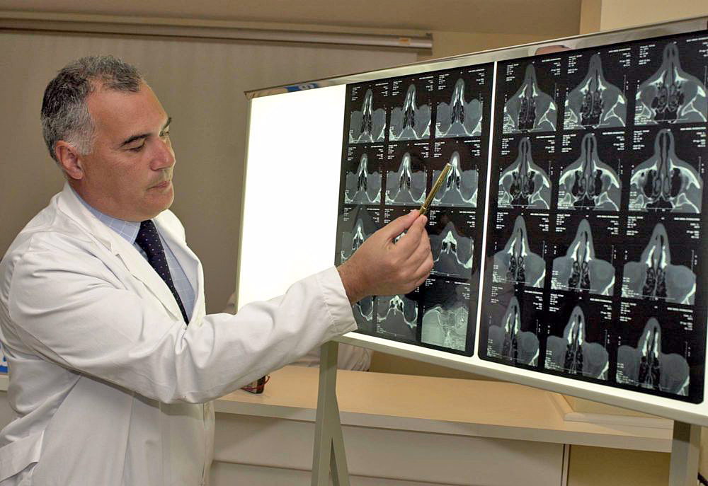 Desconocimiento de poliposis nasal retrasa el diagnóstico hasta en 4 años