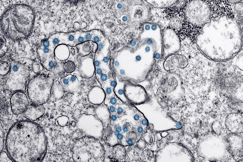 El coronavirus tiene capacidad de provocar un envejecimiento acelerado