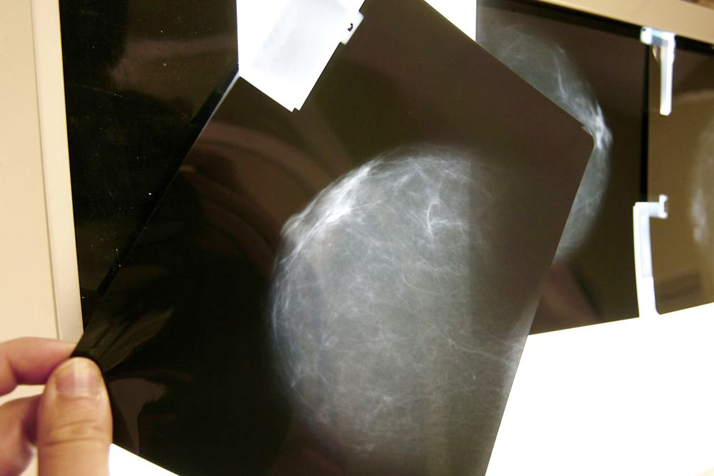¿Mamografías a los 40? Nueva pauta para la detección del cáncer de seno genera debate