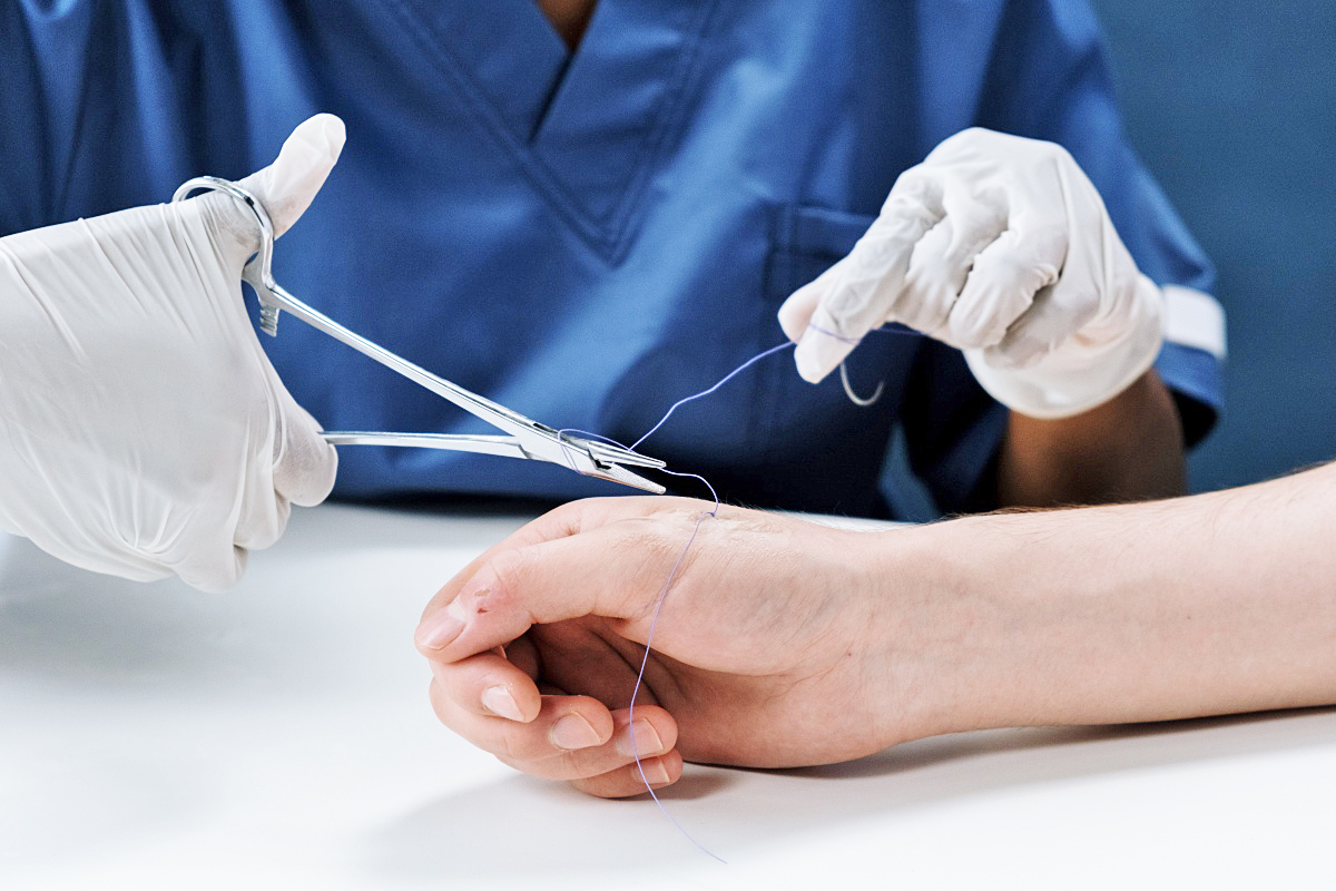 Científicos del MIT crean nuevas suturas que derivan de tejido animal