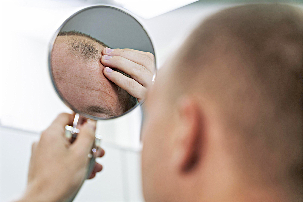 ¿Tendencia mundial? Estos son los países donde los hombres se están quedando calvos