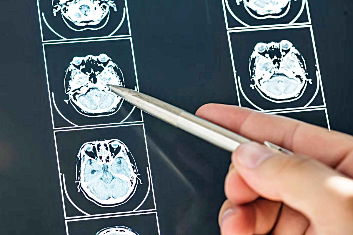 Hospital Houston Methodist revela los efectos de las hemorragias intracerebrales
