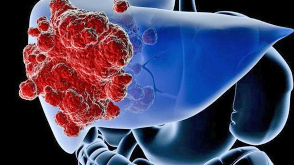 La FDA aprueba el primer tratamiento para pacientes con cicatrices hepáticas debido a la enfermedad del hígado graso