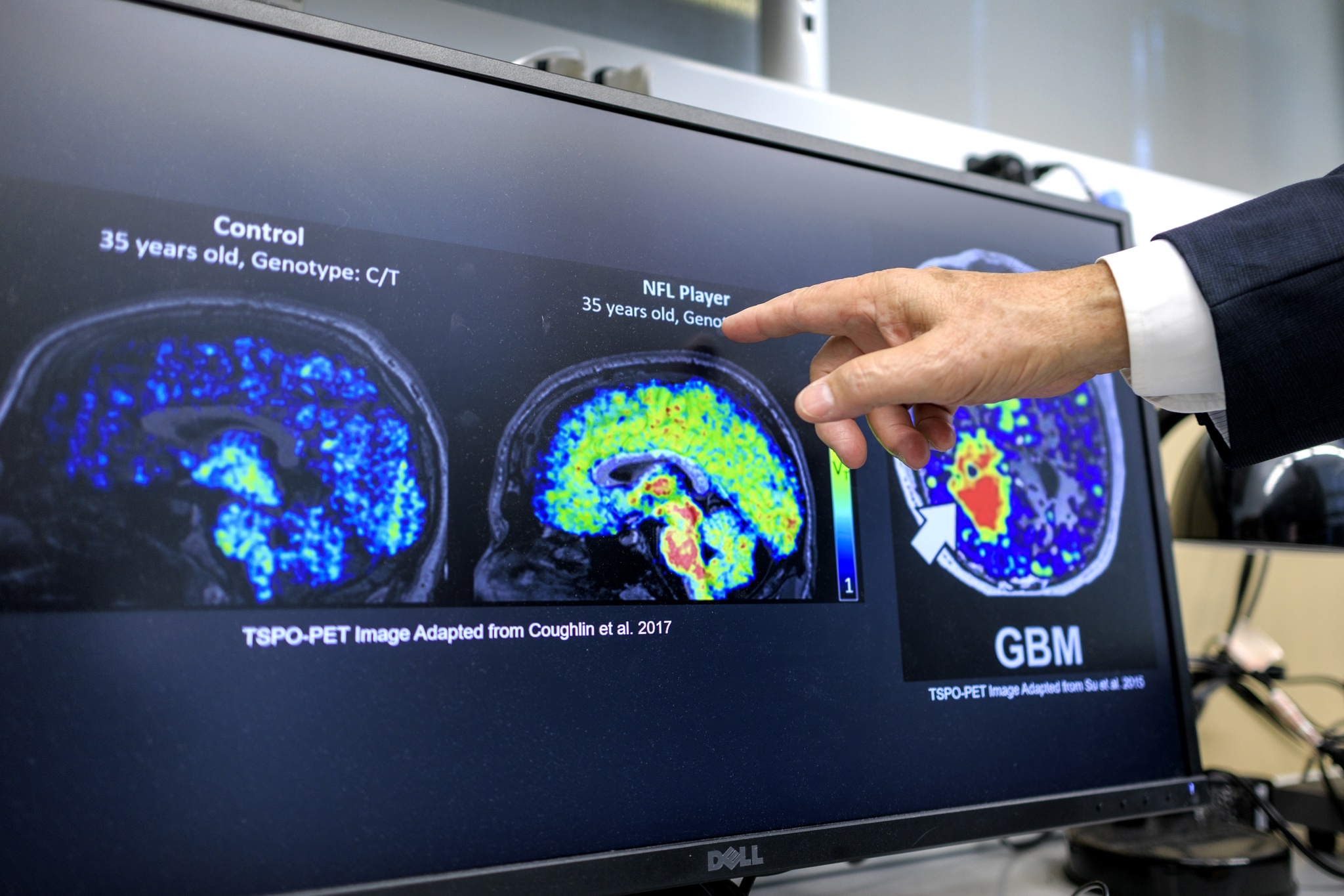 Científicos latinos en EEUU hallan biomarcador que podría detectar temprano el Alzheimer